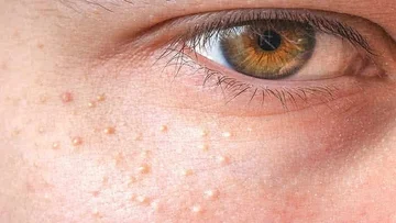 Puçrrat e vogla afër syve tregojnë për shëndetin tuaj